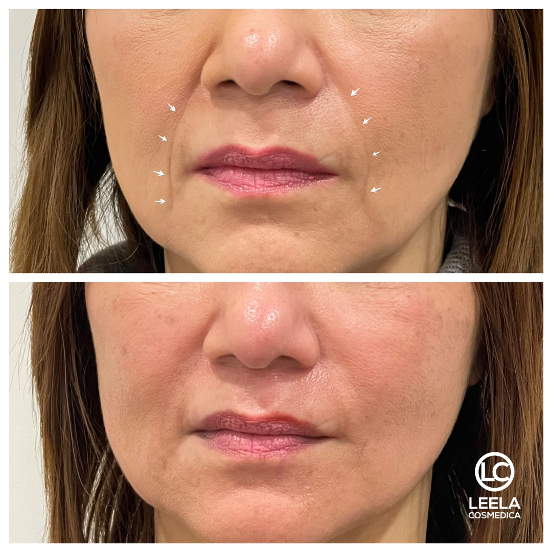 Seoul 1988 Retinal Cream - Remove Fine lines + Wrinkle & Give Clean, Tight & Glowy Skin